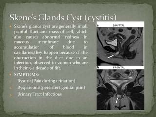 Skene’s Gland Cyst: Causes, Symptoms & Treatment